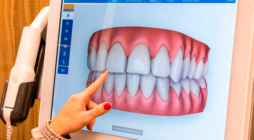 Scanner intraoral iTero